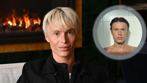 Kivuliaissa kauneusoperaatioissa käynyt Sergey Hilman: ennen ja jälkeen -kuvat! Sergey Hilman