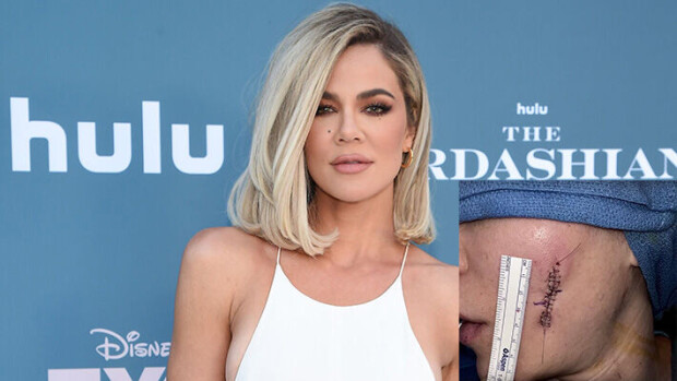 Oho, mikä arpi! Khloe Kardashianin leikkaushaava puhuttaa Khloe Kardashian