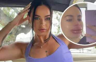 Shokkikuvat! Ilmainen täyteaine turvotti naisen huulet kaksinkertaisiksi: "Sattui helvetisti"