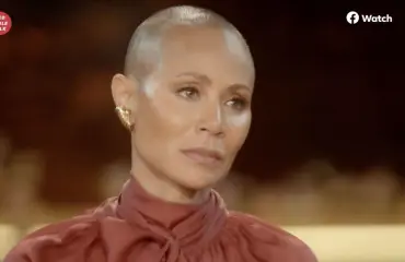 Tällainen on Jada Pinkett Smithin ja monen muunkin julkkiksen vaiva alopecia