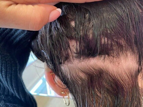 Alopecian aiheuttama hiustenlähtö on usein sosiaalisesti vaikeaa. Esimerkiksi Allergialiitosta voi hakea apua – et ole yksin, ja alla luetellut julkkiksetkin ovat tulleet sen kanssa toimeen.