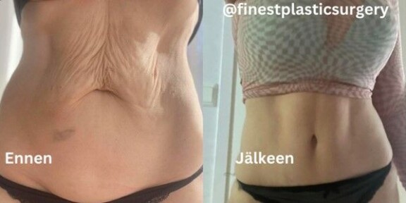 Plastiikkakirurgia Finestin suosikkileikkaus on Mommy makeover – elämää positiivisesti muuttava kauneusleikkaus