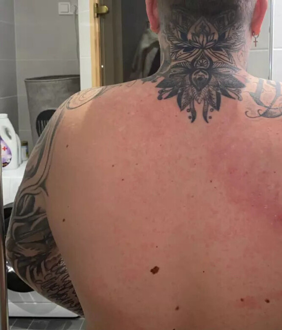 Kuvassa näkyy luomi, jonka poiston yhteydessä löytyi melanooma.