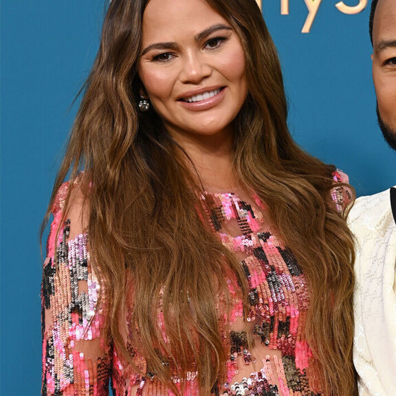 Outo kauneustrendi leviää − julkkikset hankkivat lommoposket leikkauksen avulla chrissy teigen