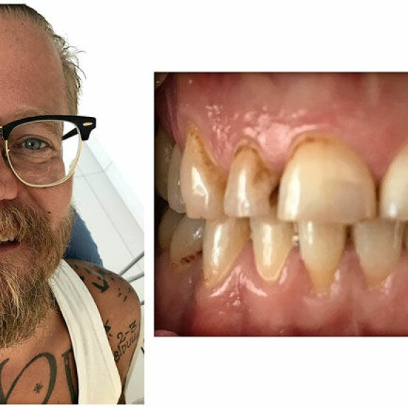Wallu Valpio päästi hampaansa huonoon kuntoon. Wallu Valpio päästi hampaansa huonoon kuntoon.