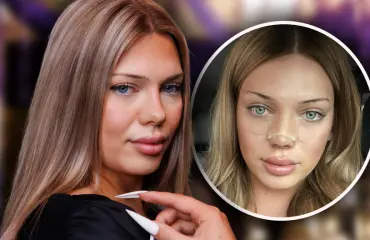 Jade Nyström kävi kauneusleikkauksessa – tältä hän näyttää nyt