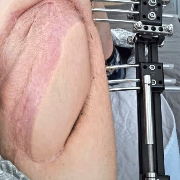 Markuksen oikea jalasta irtosi reisiluu pudotuksen seurauksena. Rautakehikko pitää miehen reiden kasassa. Markuksen oikea jalasta irtosi reisiluu pudotuksen seurauksena. Rautakehikko pitää miehen reiden kasassa.