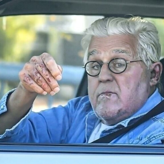 Jay Lenon alahuulessa, leuassa, korvassa ja sormissa näkyy paloarpia. jay leno