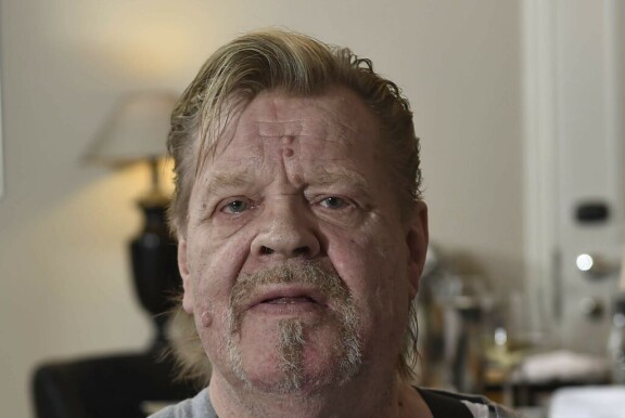 Veskun vasen silmä (kuvassa oik.) oli ruskeampi kuin hänen oikea silmänsä.