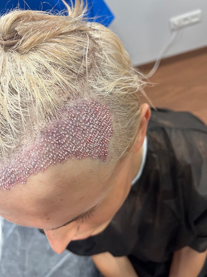 - Hiustensiirtoni tehtiin iMed-klinikalla, ja se maksoi 2500 euroa, lukuun ottamatta lentoja, Sergey kertoo asiasta kiinnostuneille. Sergey Hilman