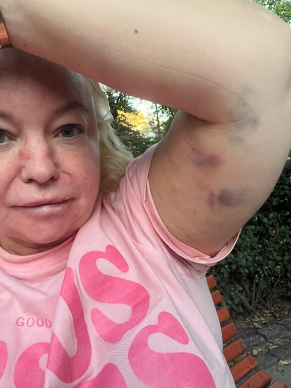 Johanna liikkui laivalla pinkissä, Jeesusta ylistävässä t-paidassa. Risteilyn jälkeen hän väitti vartioiden pahoinpidelleen hänet. Johanna Tukiainen näyttää laivareissun jälkeisiä mustelmiaan lääkärille lokakuunssa 2025.