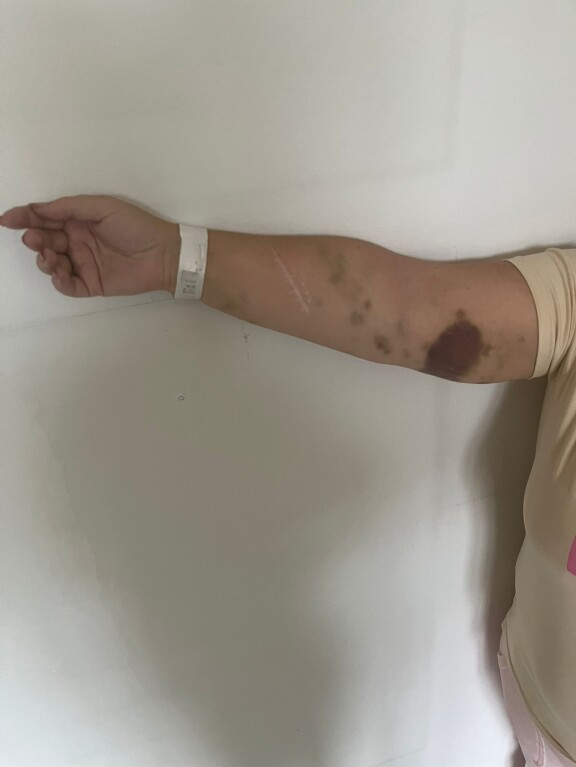 Johanna kuvattiin sairaalassa heti ristelyn jälkeen. Isot mustelmat käsivarsissa ovat muistona karusta risteilystä. Johanna Tukiainen näyttää laivareissun jälkeisiä mustelmiaan lääkärille lokakuunssa 2025.