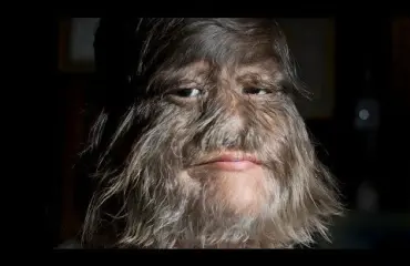 Maailman karvaisin tyttö löysi rakkauden - katso video!