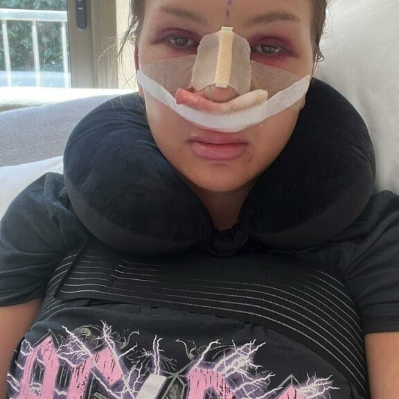 Leikkauksen jälkeisenä päivänä Ella voi erittäin huonosti. Pari päivää myöhemmin nenässä olleet putkilot poistettiin, ja myös tikit otettiin jo pois. Leikkauksen jälkeisenä päivänä Ella voi erittäin huonosti. Pari päivää myöhemmin nenässä olleet putkilot poistettiin, ja myös tikit otettiin jo pois.