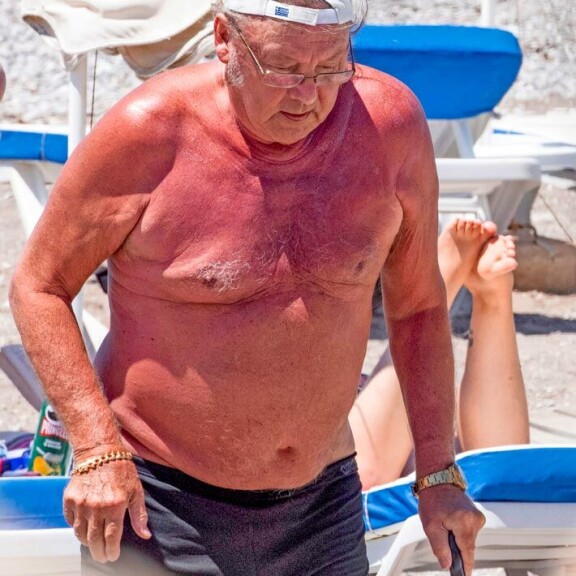 Danny ja Erika viettivät tuntikausia Rodoksen hiekkarannalla, mikä ei tehnyt legendaarisen laulajan hipiälle hyvää. Danny paloi pahemman kerran. Danny ja Erika viettivät tuntikausia Rodoksen hiekkarannalla, mikä ei tehnyt legendaarisen laulajan hipiälle hyvää. Danny paloi pahemman kerran.