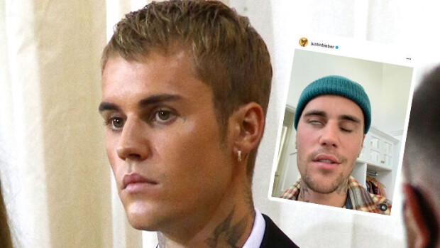 Justin Bieberin kasvot halvaantuivat! Kärsii harvinaisesta sairaudesta Justin Bieber