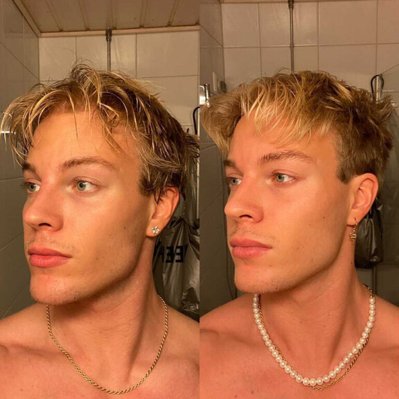 Täyteaineet poistattanut Mikael kertoo olevansa tyytyväinen lopputulokseen. Vasemmalla kuva ennen poisto-operaatiota. Mikael Renwall