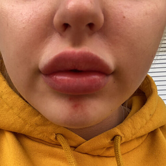 Tältä Julian huulet näyttävät tällä hetkellä. Julia