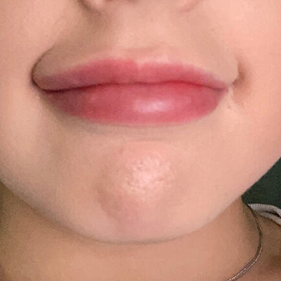 Julia kertoo huultensa tuntuvan epätasaisilta. - Huomasin möykkyjä sekä epätasaisuutta niissä, Julia sanoo. Julia