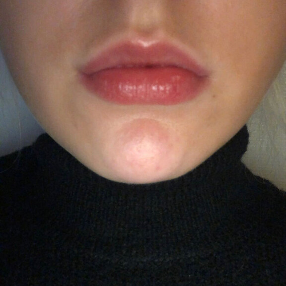 Julian huulet ilman täyteaineita. Julia