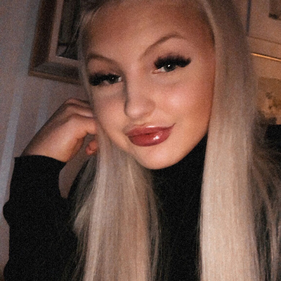 Tältä Julian huulet näyttivät ensimmäisen täyttökerran jälkeen. Julia