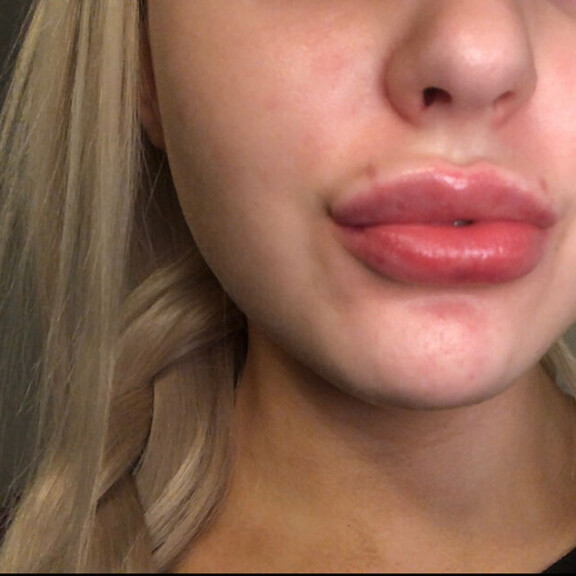 Tältä Julian huulet näyttivät ensimmäisen täyttökerran jälkeen. Julia