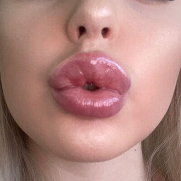 Nämä huulitäytteet eivät miellyttäneet Juliaa. - Laiton jälkeen huomasin, että huulitäytteet oli ihan päin helvettiä. Julia