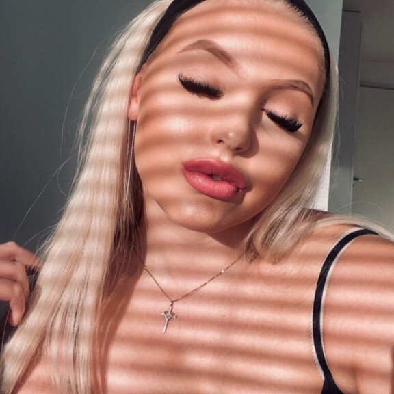 Kuvat ei herkille! 'Huulitäytteet ihan päin helvettiä' - EOTB-Julian kauneushoito meni pahasti pieleen: 'Huuleni ovat pilalla!' Julia