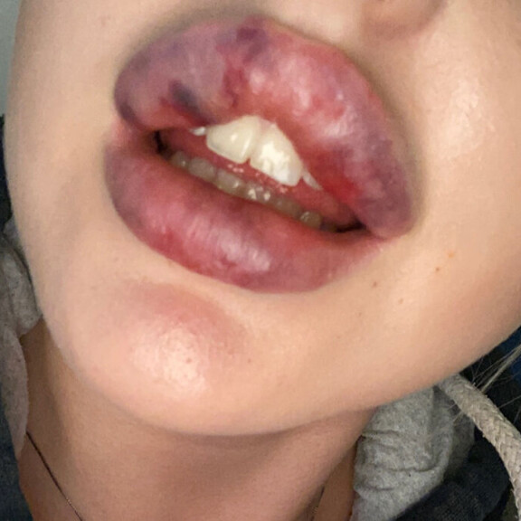 Julian huulet korjaustäytön jälkeen. Julia