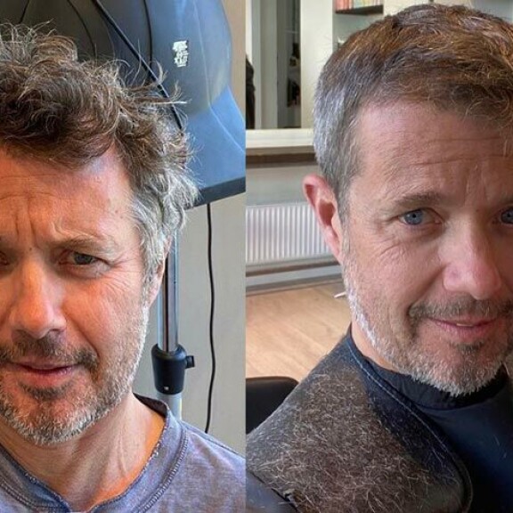 Prinssi Frederik ennen ja jälkeen hiusoperaation. Prinssi Frederik ennen ja jälkeen hiusoperaation.