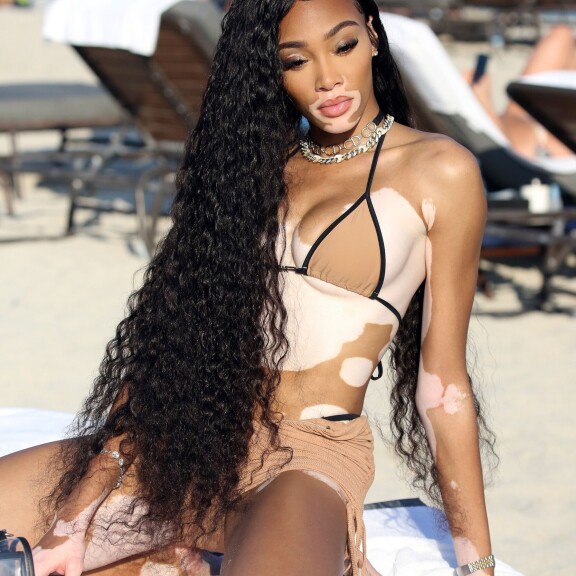 Yksi maailman upeimmista naisista! Pigmenttipoikkeamallaan erottuva Winnie Harlow keimaili bikineissä - katso kuumat rantakuvat! xx