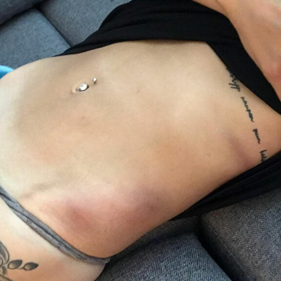 Temptation Island -Tonista rikosilmoitus! Epäillään pahoinpitelystä: Laurakiira joutui sairaalaan - kuvat vammoista! Laurakiira