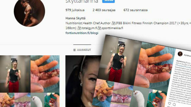 Ei herkille! Suomalaisen fitness-tähden käteen pesiytyi lihansyöjäbakteeri - kammottavat kuvat! Hanna Skyttä