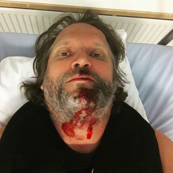 Radio Rockin Kim Sainio rajussa skootterionnettomuudessa - sai pahoja vammoja: Syy oli täysin minun! Kim Sainio