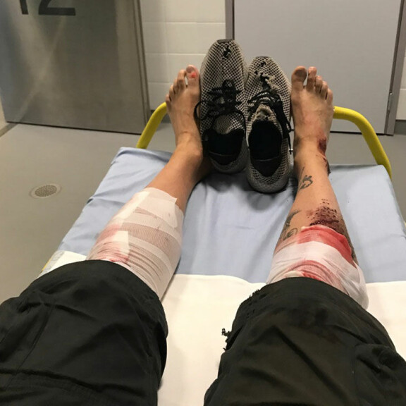 Radio Rockin Kim Sainio rajussa skootterionnettomuudessa - sai pahoja vammoja: Syy oli täysin minun! Kim Sainio