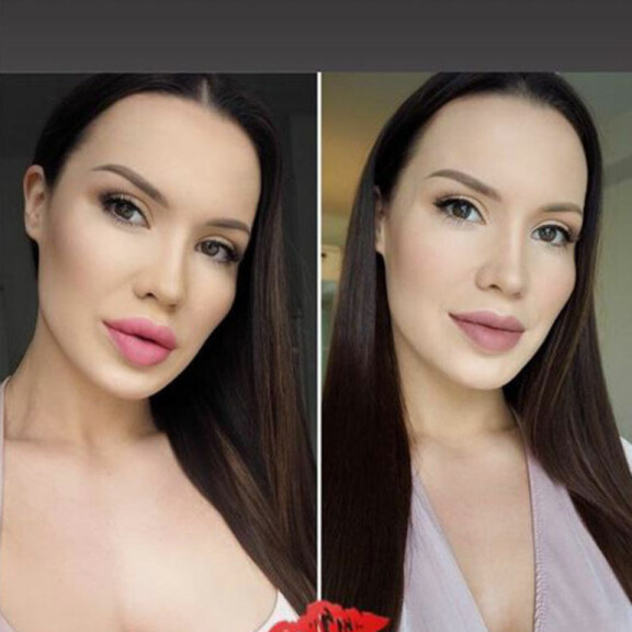 Ohhoh, Mailis Penttilä poistatti huulitäytteensä: Minulta kysytään paljon, miltä näytin ennen - katso kuva! mailis