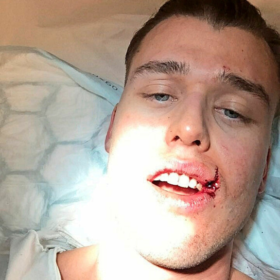 Hurjat kuvat vammoista: Paratiisihotelli-sarjan Aleksi, 26, hakattiin Summer Up -risteilyllä – ”Iskuja sateli joka puolelta!” Aleksi Jorila hakattiin laivalla.