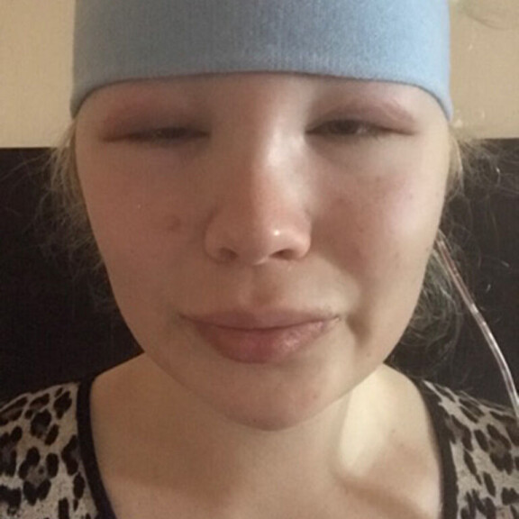 Elena Vikströmin jättimäinen kauneusleikkaus: otsaluita hiottiin naisellisemmiksi – katso hurja jälkeen-kuva! elena vikström