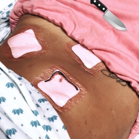 Maisa Torppa julkaisi järkyttävät sairaalakuvat - ulkonäkö hämmentää! Maisa Torppa Insta