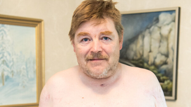 Kuva ei herkille - Jyrki, 50, poltti pihallaan jätteitä kohtalokkain seurauksin: Puolet vartalostani tuhoutui – iho kuorittiin pois! Jyrki Peltoniemi paloi pahoin 2014.