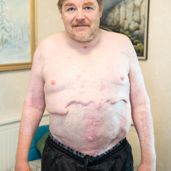 Kuva ei herkille - Jyrki, 50, poltti pihallaan jätteitä kohtalokkain seurauksin: Puolet vartalostani tuhoutui – iho kuorittiin pois! Jyrki Peltoniemi paloi rinnasta alaspäin.