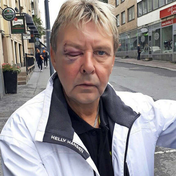 Matti Nykäsen raju ryyppyputki päättyi karusti: makasi tajuttomana Tampereen kadulla, silmä muurautui – pysäyttävä kuva! Matti