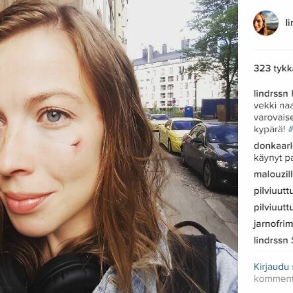 Li Andersson pyöräkolarissa: tikkejä naamassa ja musta silmä – kuva!