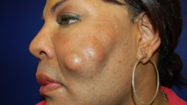 Sementillä pilattu nainen pääsi vihdoinkin leikkaukseen: huima muodonmuutos! Sementillä pilattu nainen pääsi vihdoinkin leikkaukseen: huima muodonmuutos!