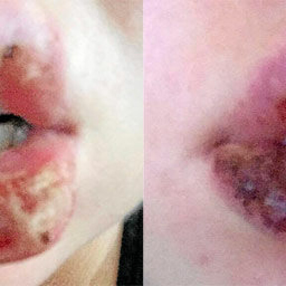 Henna Kalinaisella todella paha huuliherpes - rajut kuvat! Ei herkille!