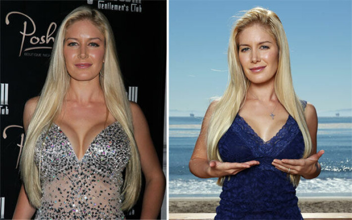 Heidi Montag pienennytti rintansa: Kumpi on parempi, F- vai C-kuppi?